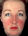 Rosacea:  Related to ME/CFS & FM?